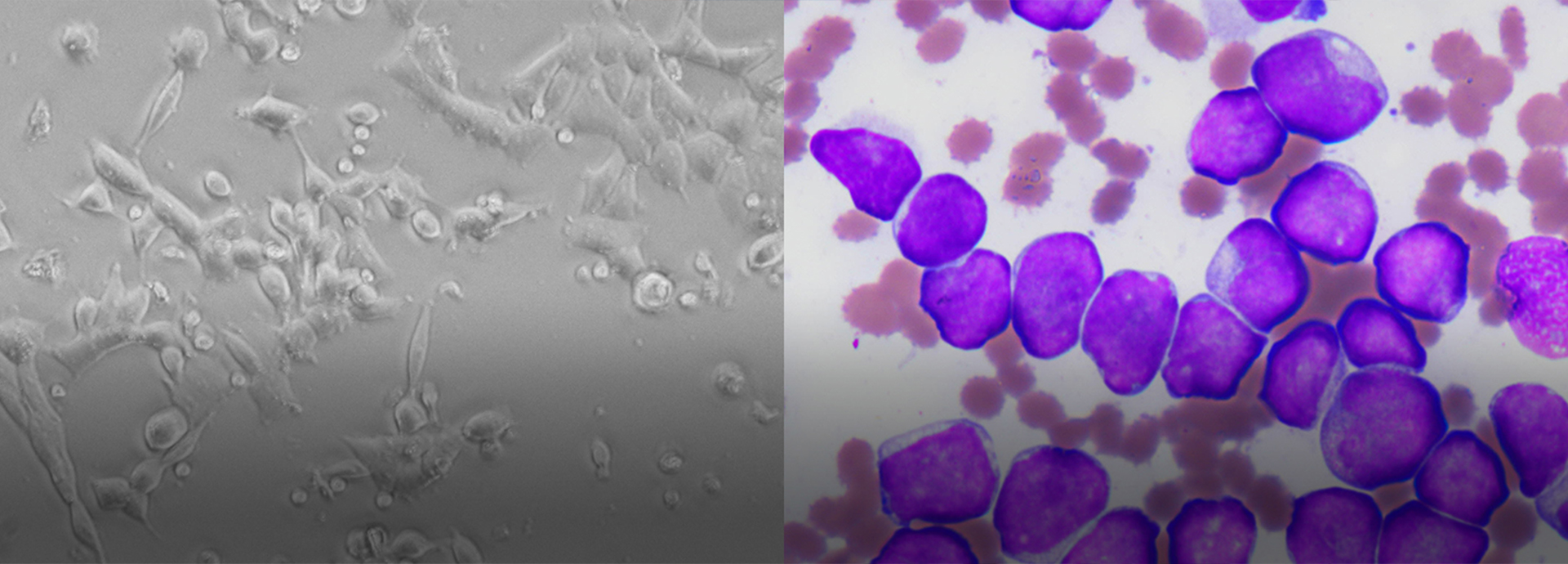 Cure blood cancer without transplantation by establishing new cell therapy
